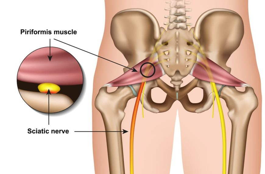 Do Tight Hip Flexors Cause Weak Glutes? Learn How Piriformis Is Affected