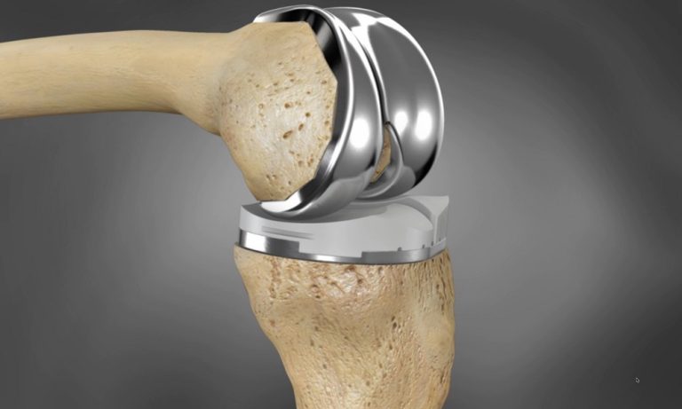 3D Printed Knee Replacement: Revolutionizing Joint Surgeries