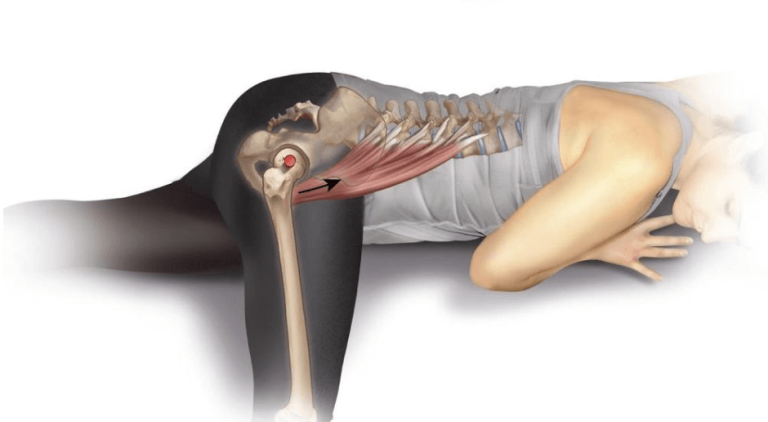 Hip Flexor Tendonitis After Hip Replacement: Causes, Treatment, and Prevention