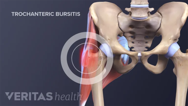 Hip Tendonitis vs Bursitis: Causes, Symptoms, and Treatment